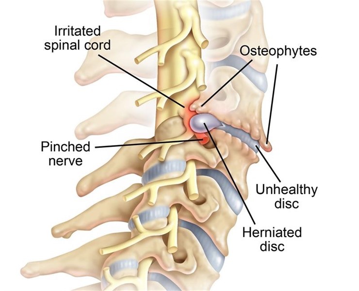 Neck pain